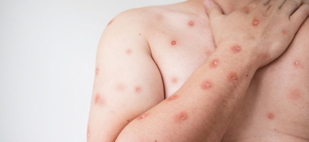 SES alerta para monitoramento de casos de Mpox em MT após avanço de variante em Rondônia